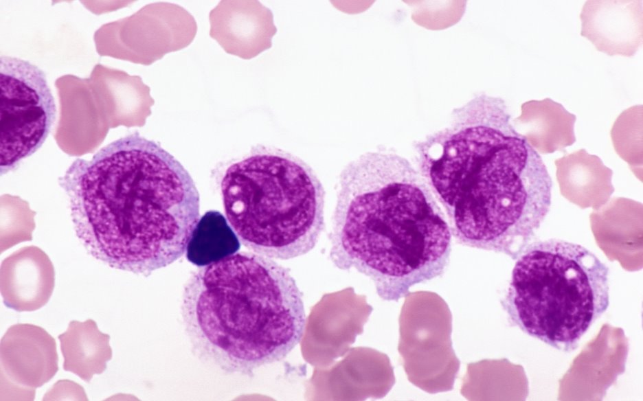 Acute Monocytic Leukemia Pathology Student