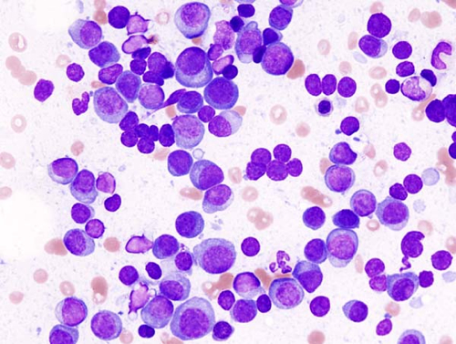 What Is M Spike In Multiple Myeloma