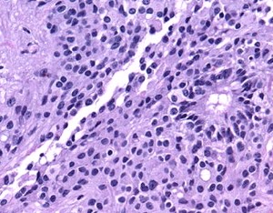 The Four Main Types Of Rosettes In Pathology 