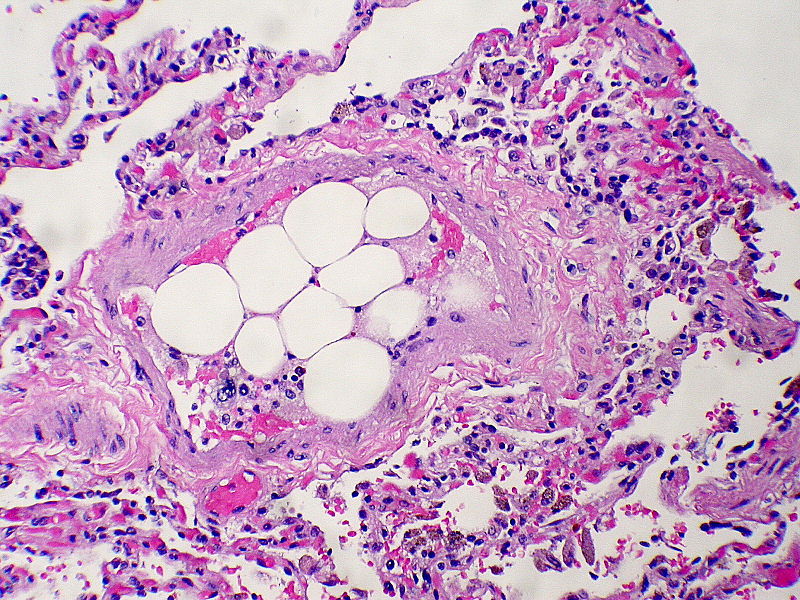 Thrombus Embolus